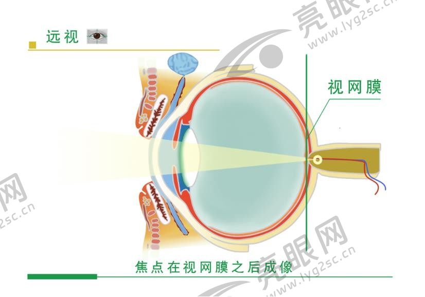 远视眼手术